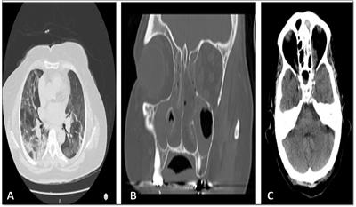 Invasive Fusarium rhinosinusitis in COVID-19 patients: report of three cases with successful management